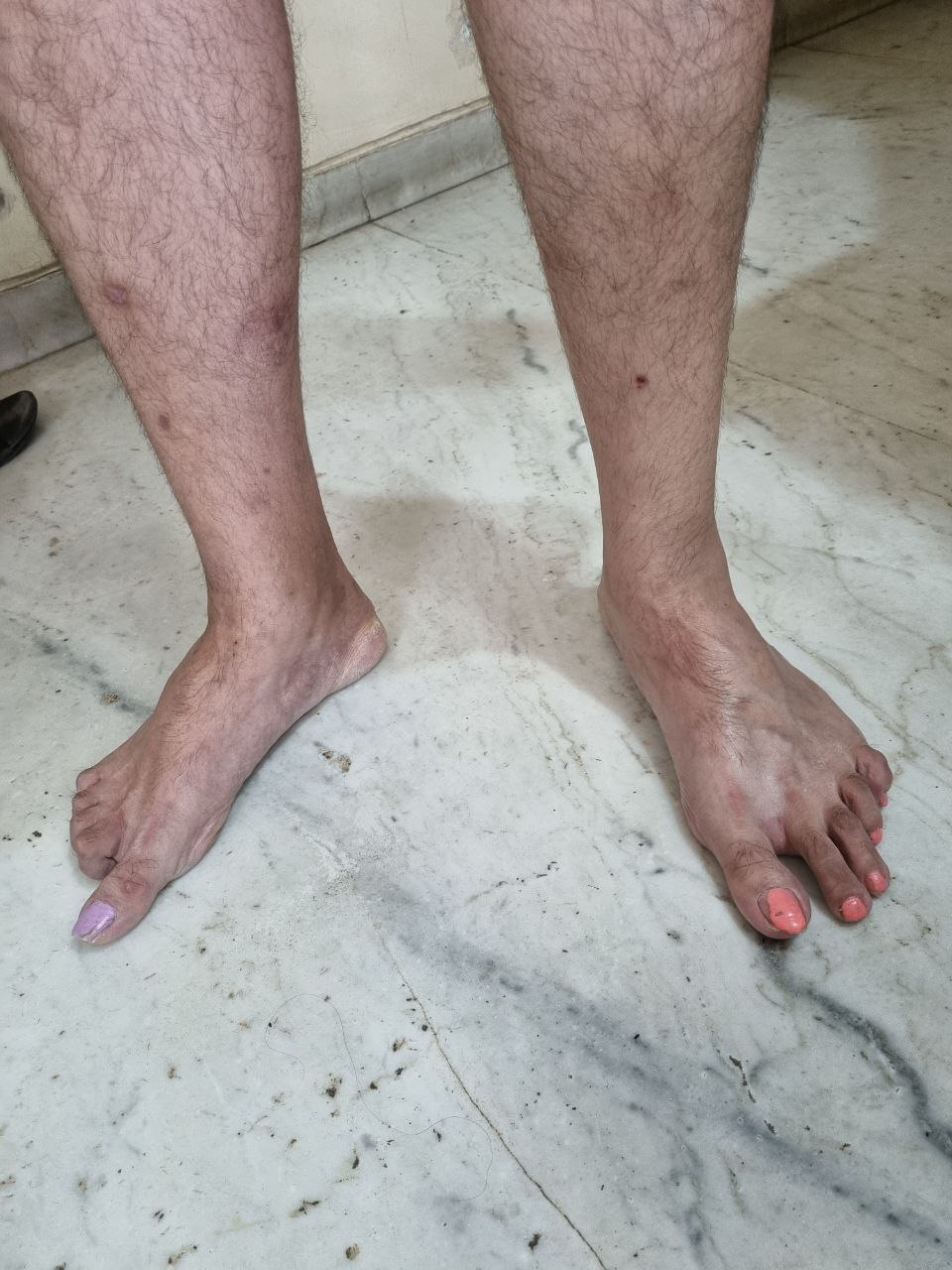 Hammer Toe Deformity